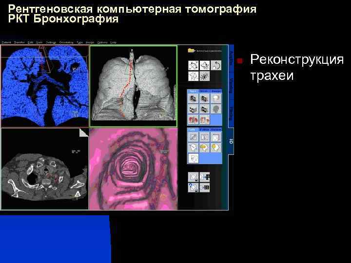 Рентгеновская компьютерная томография РКТ Бронхография n Реконструкция трахеи 