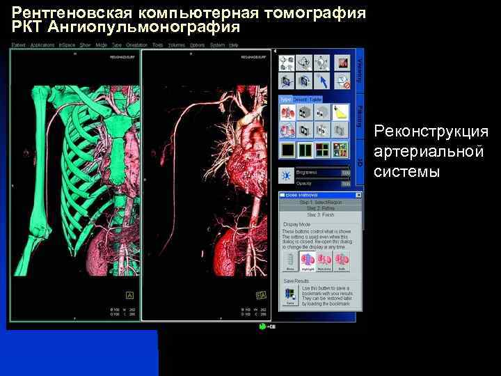 Рентгеновская компьютерная томография РКТ Ангиопульмонография Реконструкция артериальной системы 