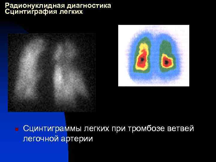 Радионуклидная диагностика Сцинтиграфия легких n Сцинтиграммы легких при тромбозе ветвей легочной артерии 