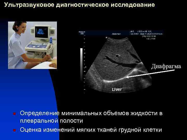 Ультразвуковое диагностическое исследование Диафрагма n n Определение минимальных объемов жидкости в плевральной полости Оценка