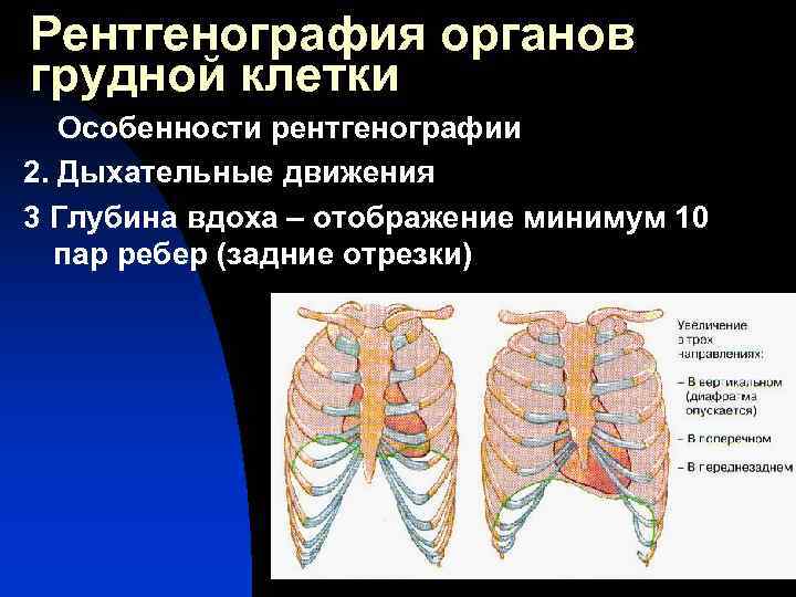 Рентгенография органов грудной клетки Особенности рентгенографии 2. Дыхательные движения 3 Глубина вдоха – отображение