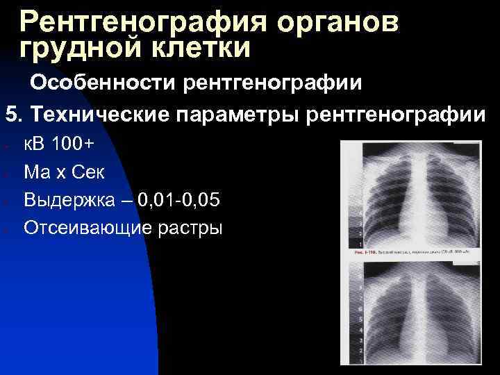Рентгенография органов грудной клетки Особенности рентгенографии 5. Технические параметры рентгенографии - к. В 100+