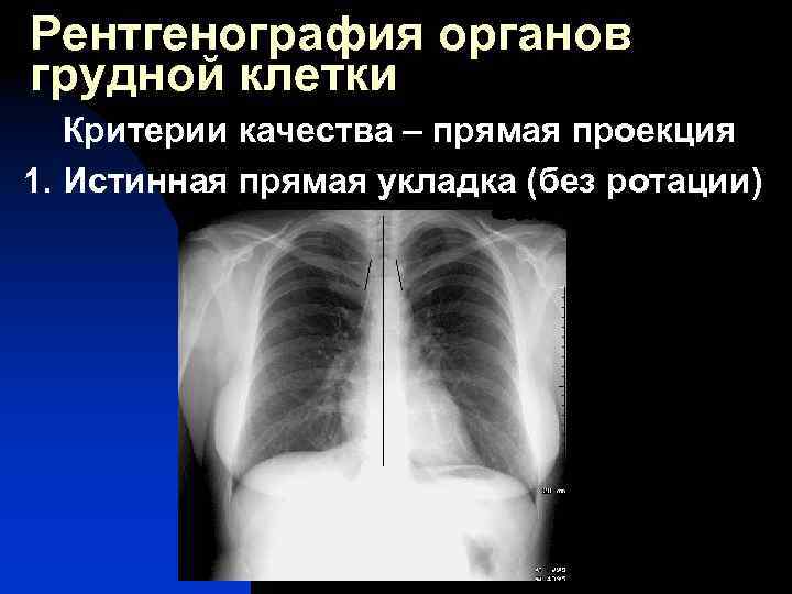 Рентгенография органов грудной клетки Критерии качества – прямая проекция 1. Истинная прямая укладка (без