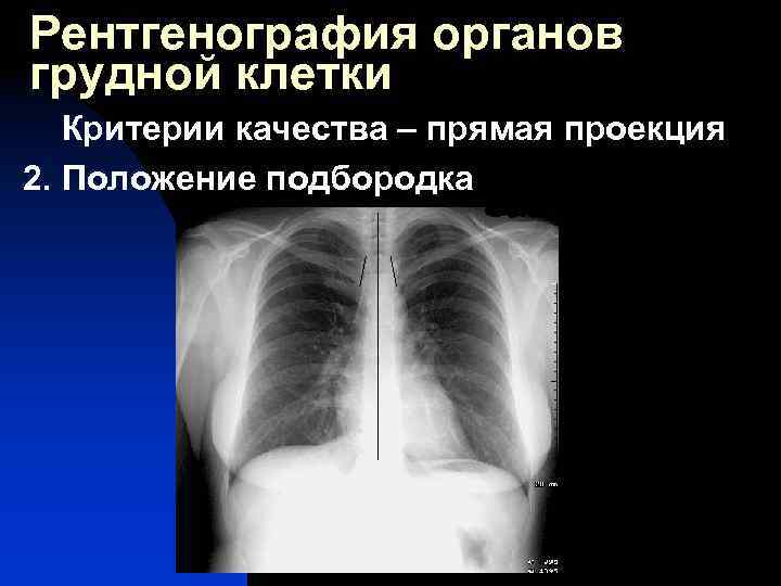 Рентгенография органов грудной клетки Критерии качества – прямая проекция 2. Положение подбородка 