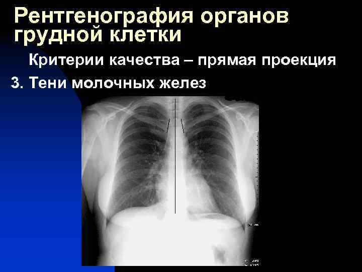 Рентгенография органов грудной клетки Критерии качества – прямая проекция 3. Тени молочных желез 