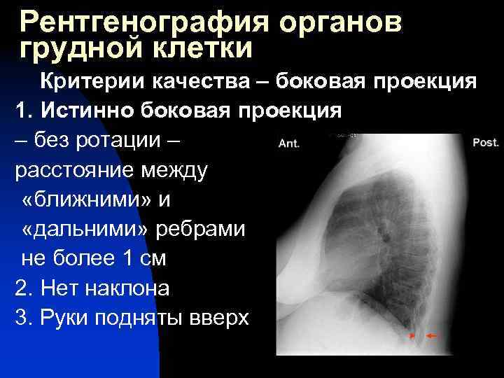 Рентгенография органов грудной клетки Критерии качества – боковая проекция 1. Истинно боковая проекция –