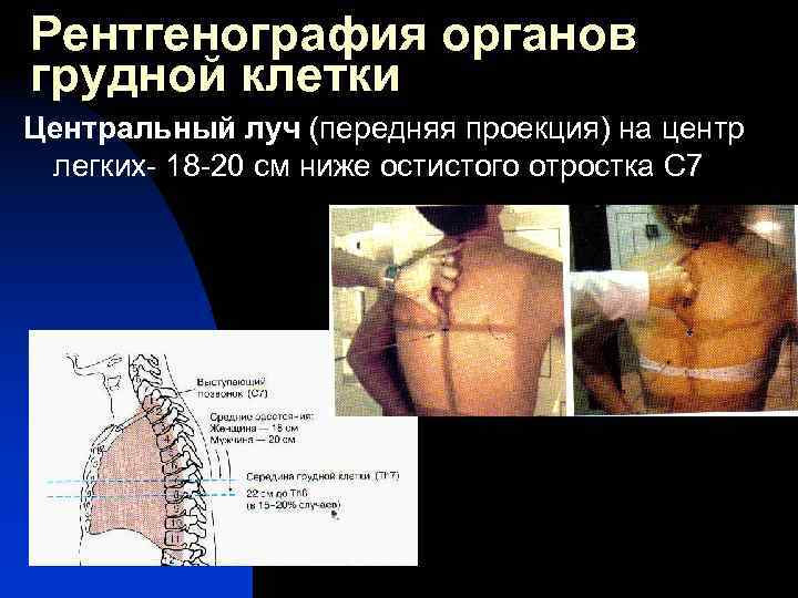 Рентгенография органов грудной клетки Центральный луч (передняя проекция) на центр легких- 18 -20 см