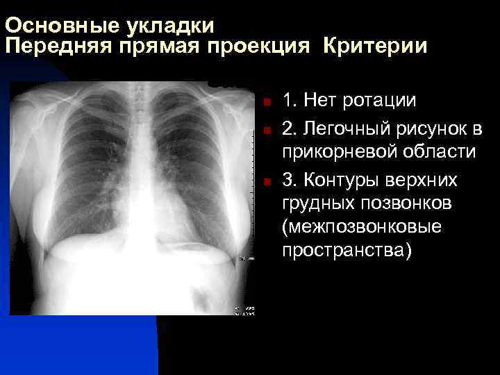 Основные укладки Передняя прямая проекция Критерии n n n 1. Нет ротации 2. Легочный