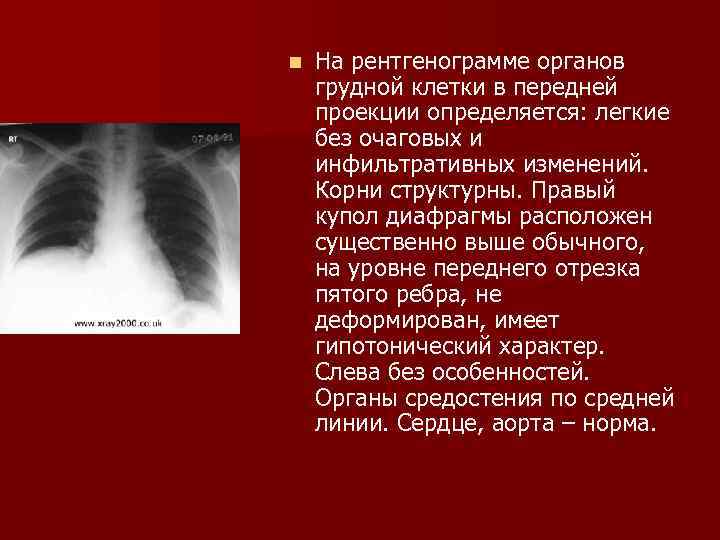 На компьютерной томограмме органов грудной клетки трахея определяется как