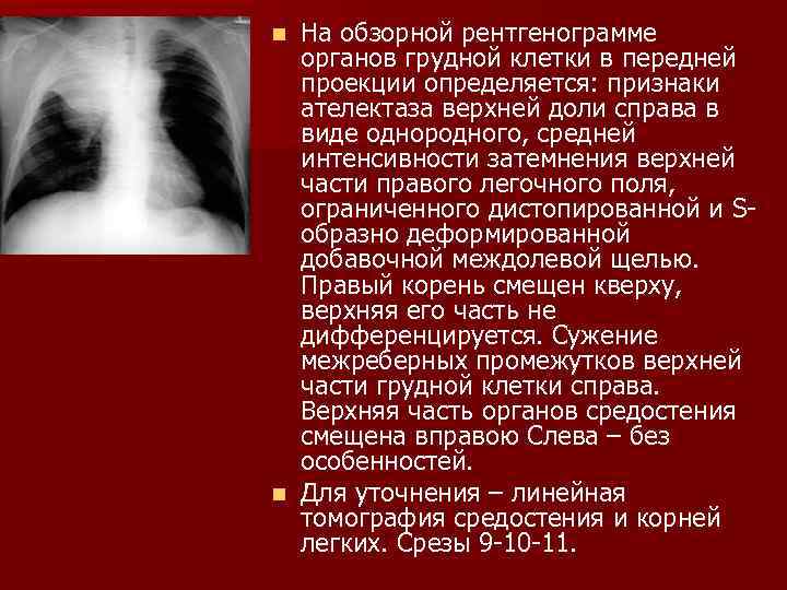 На рентгенограмме органов грудной клетки легочный рисунок в норме является