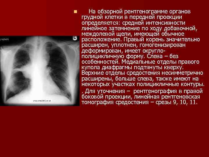 Схема описания рентгенограммы легких