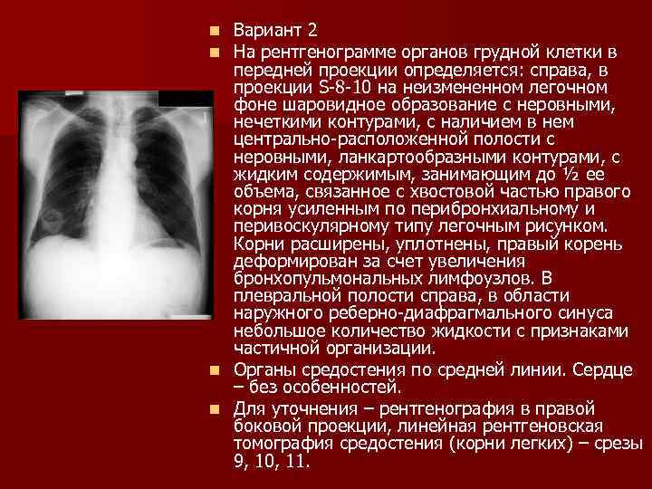 Легочный рисунок усилен за счет перибронхиального компонента