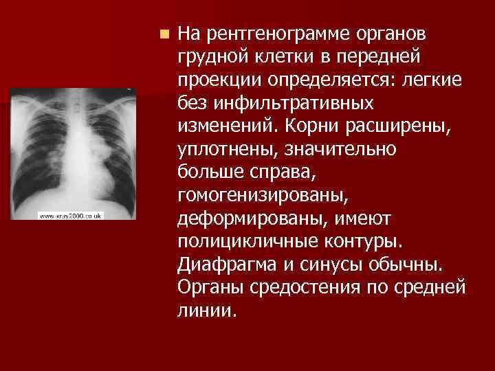 На компьютерной томограмме органов грудной клетки трахея определяется как