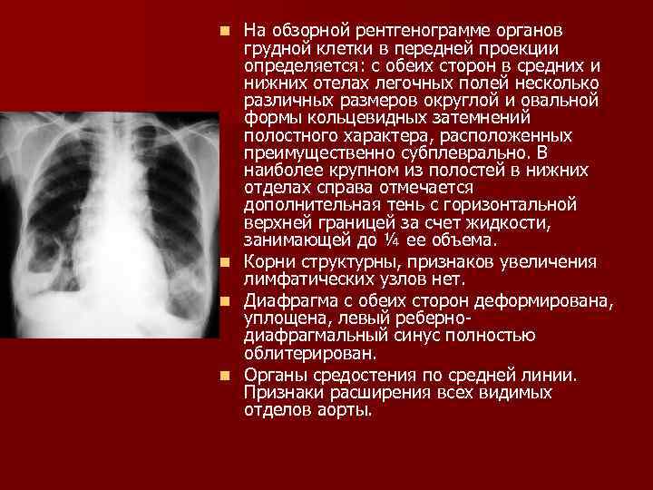 На компьютерной томограмме органов грудной клетки трахея определяется как