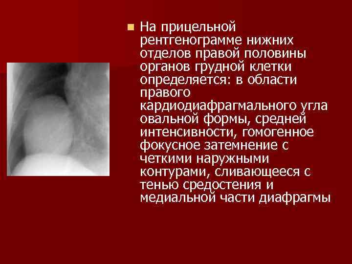 n  На прицельной рентгенограмме нижних отделов правой половины органов грудной клетки определяется: в