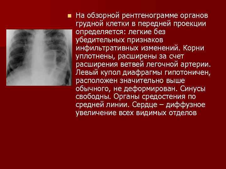 На рентгенограмме органов грудной клетки легочный рисунок в норме является