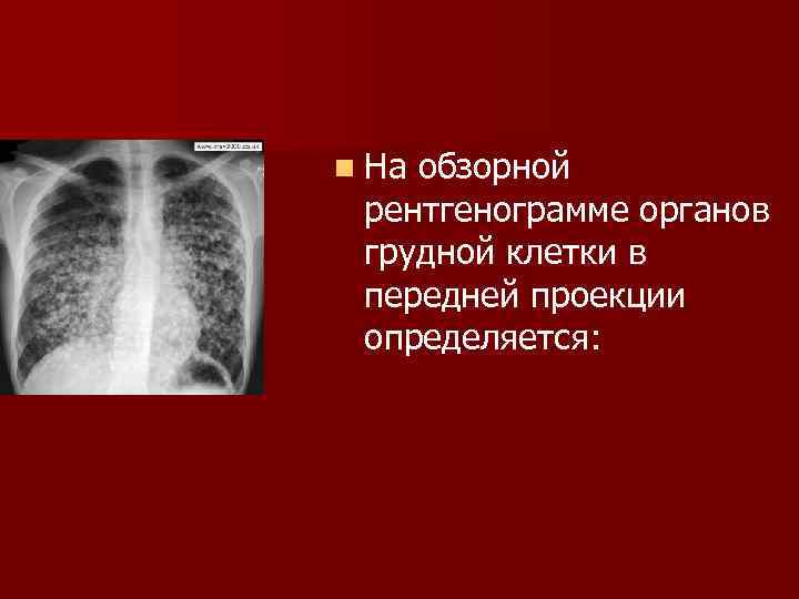 На компьютерной томограмме органов грудной клетки трахея определяется как