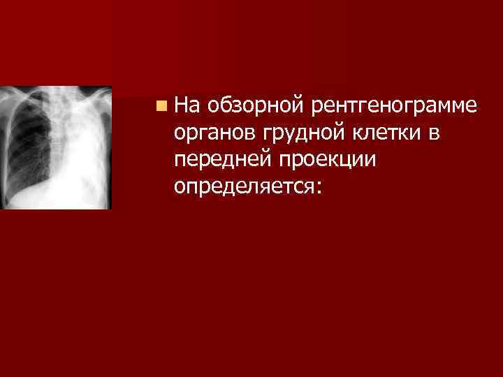 Синусы облитерированы. Шаблоны описания рентгенограмм. Облитерирован синус легкого. Синус облитерирован рентген. Облитерирован синус легких рентген.