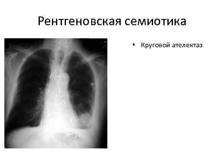 Рентгеновская семиотика    • Круговой ателектаз 