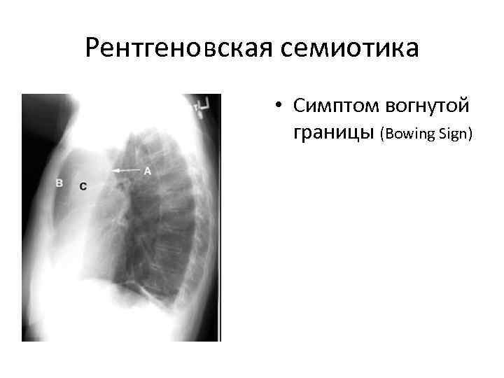 Рентгеновская семиотика    • Симптом вогнутой    границы (Bowing Sign)