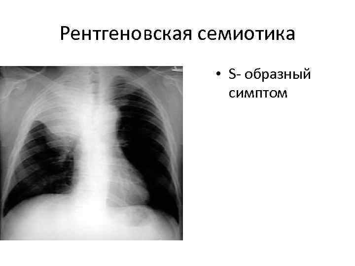 Рентгеновская семиотика   • S- образный   симптом 
