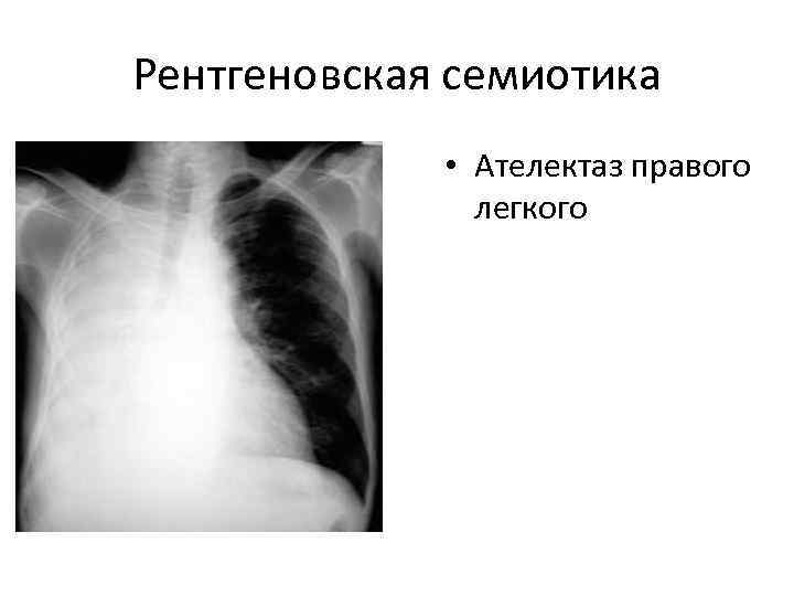 Рентгеновская семиотика    • Ателектаз правого    легкого 