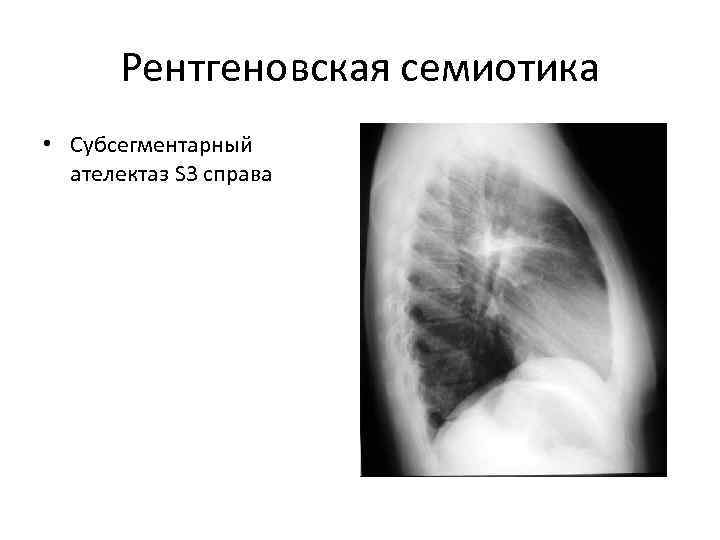  Рентгеновская семиотика • Субсегментарный  ателектаз S 3 справа 
