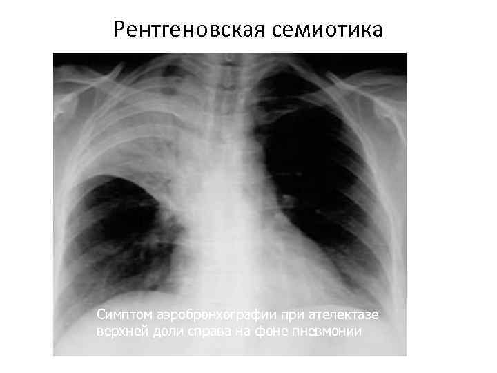  Рентгеновская семиотика Симптом аэробронхографии при ателектазе верхней доли справа на фоне пневмонии 