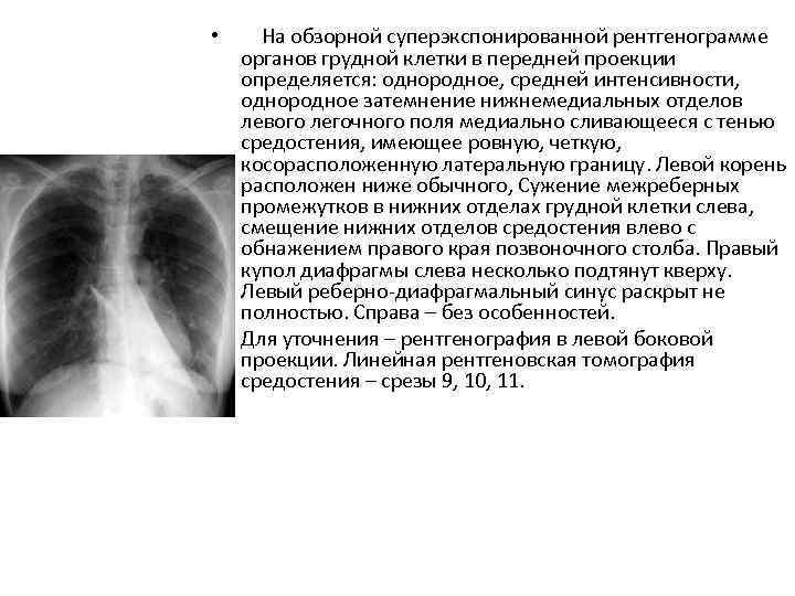  •  На обзорной суперэкспонированной рентгенограмме  органов грудной клетки в передней проекции