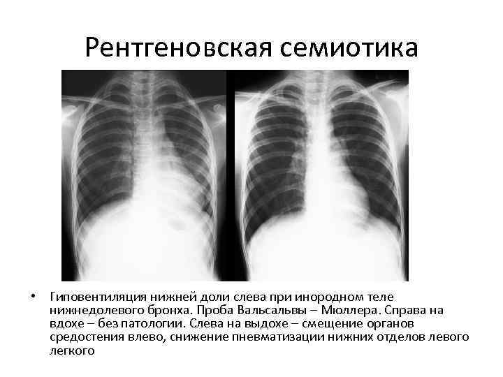   Рентгеновская семиотика • Гиповентиляция нижней доли слева при инородном теле  нижнедолевого