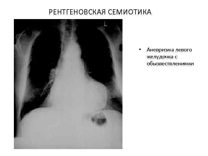 РЕНТГЕНОВСКАЯ СЕМИОТИКА • Аневризма левого желудочка с обызвествлениями 