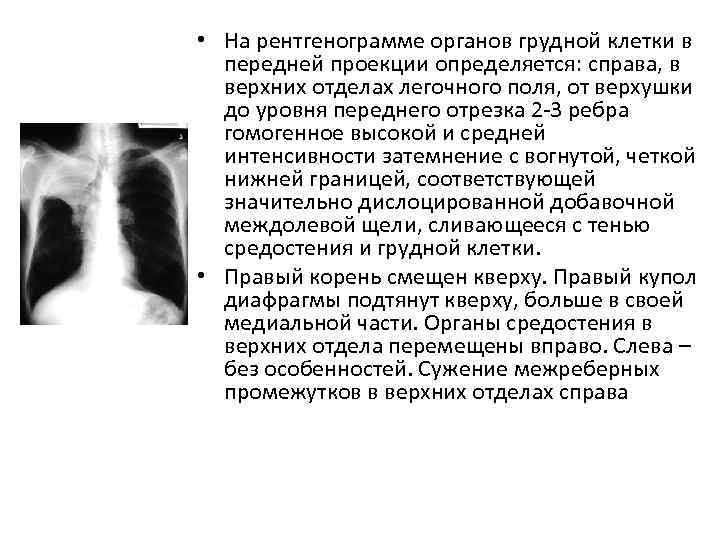  • На рентгенограмме органов грудной клетки в передней проекции определяется: справа, в верхних