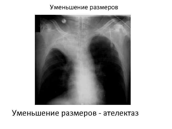 Уменьшение размеров - ателектаз 