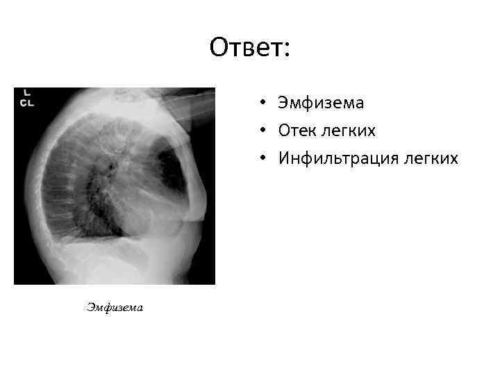 Ответ: • Эмфизема • Отек легких • Инфильтрация легких Эмфизема 