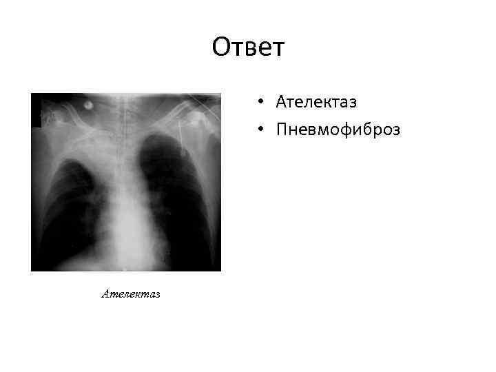 Ответ • Ателектаз • Пневмофиброз Ателектаз 