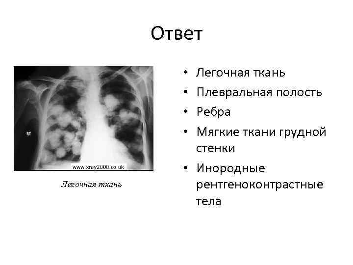 Ответ Легочная ткань Плевральная полость Ребра Мягкие ткани грудной стенки • Инородные рентгеноконтрастные тела