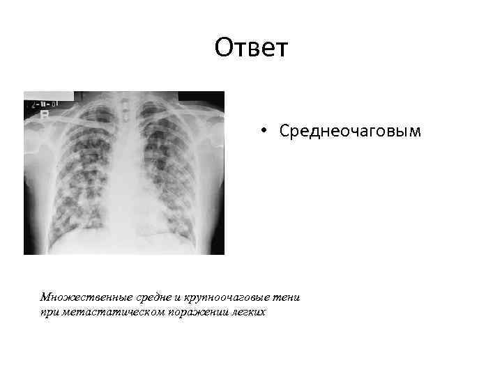 Ответ • Среднеочаговым Множественные средне и крупноочаговые тени при метастатическом поражении легких 