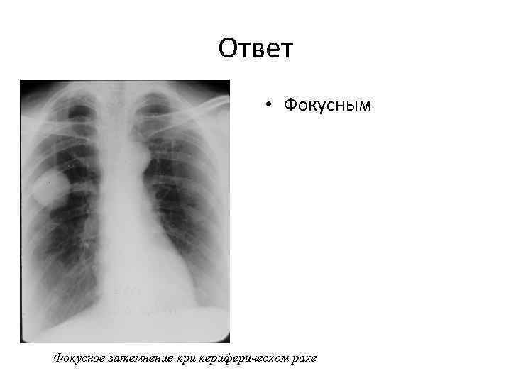 Ответ • Фокусным Фокусное затемнение при периферическом раке 