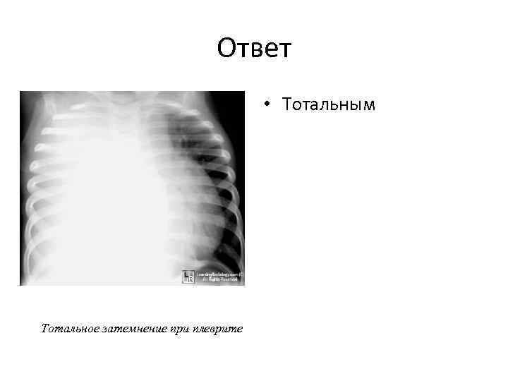 Ответ • Тотальным Тотальное затемнение при плеврите 