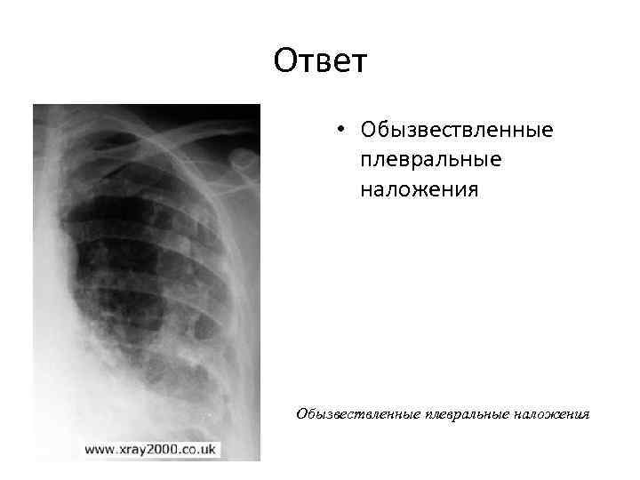 Ответ • Обызвествленные плевральные наложения 