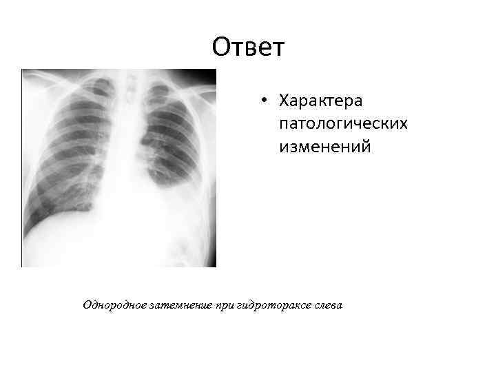 Ответ • Характера патологических изменений Однородное затемнение при гидротораксе слева 