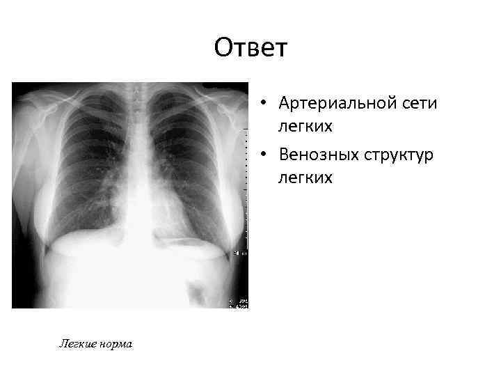 Ответ • Артериальной сети легких • Венозных структур легких Легкие норма 