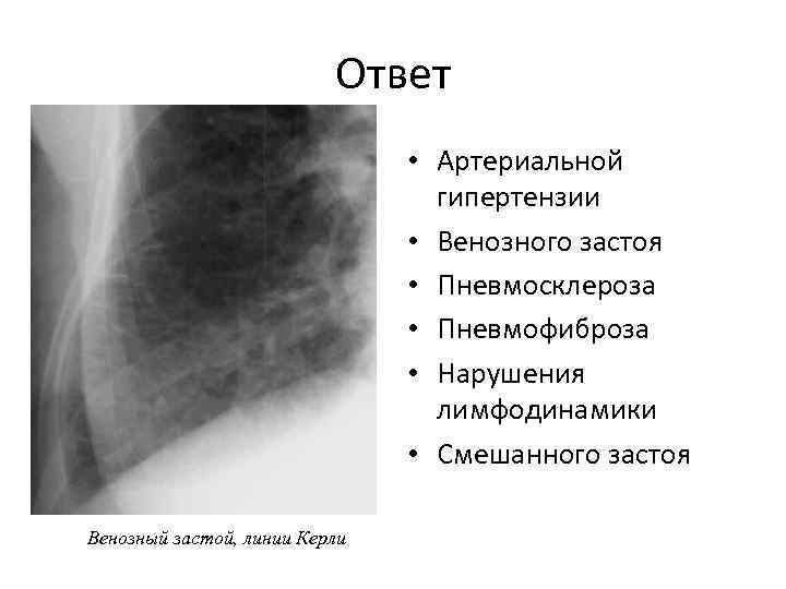 Пневмосклероз это простыми словами. Перегородочные линии Керли. Линии Керли в легких на рентгене. Пневмосклероз рентген описание.