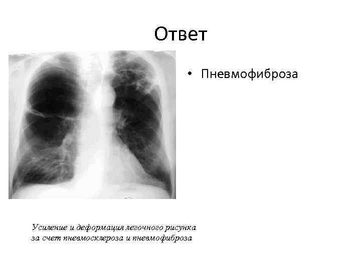 Легочный рисунок деформирован за счет пневмосклероза что это значит