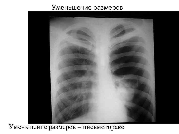 Уменьшение размеров – пневмоторакс 