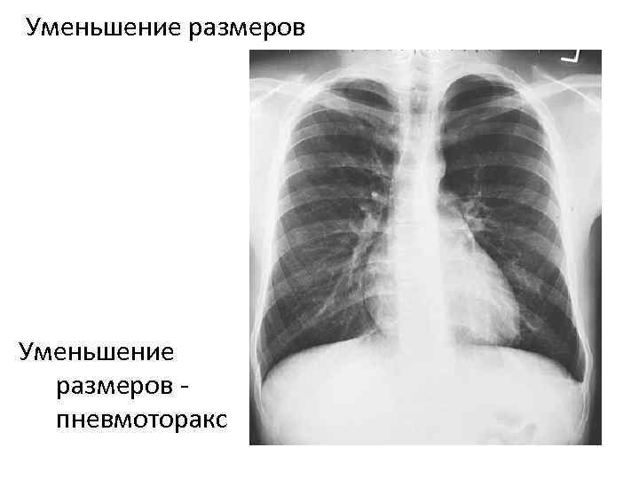 Уменьшение размеров пневмоторакс 