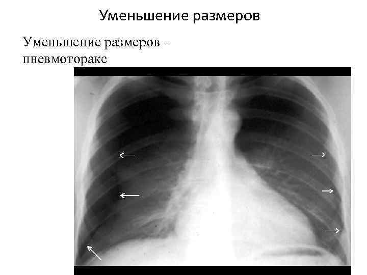 Уменьшение размеров – пневмоторакс 