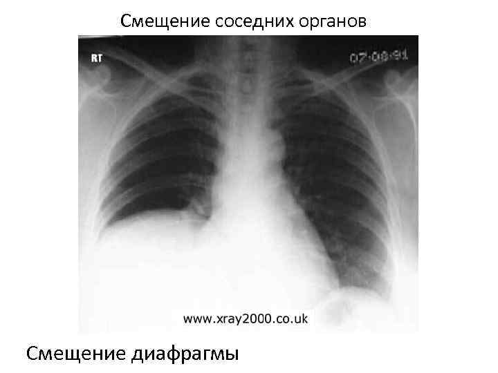 Смещение соседних органов Смещение диафрагмы 
