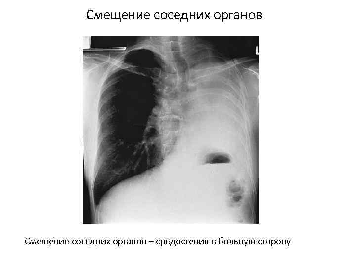 Смещение соседних органов – средостения в больную сторону 
