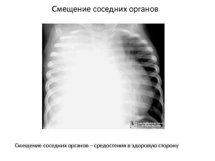 Смещение соседних органов – средостения в здоровую сторону 